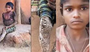 दंतेवाड़ा में दुर्लभ बीमारी का मामला